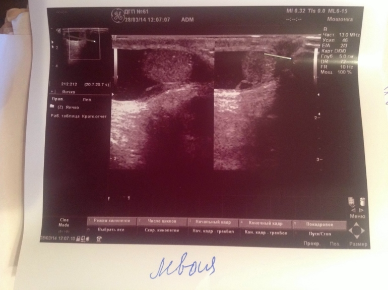 Водянка+гипоэхогенная струтура и включения в яичке!