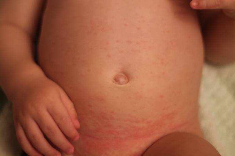 сыпь , ребенку год и меяц