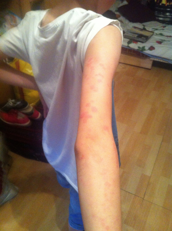 Острая крапивница посетила нас(