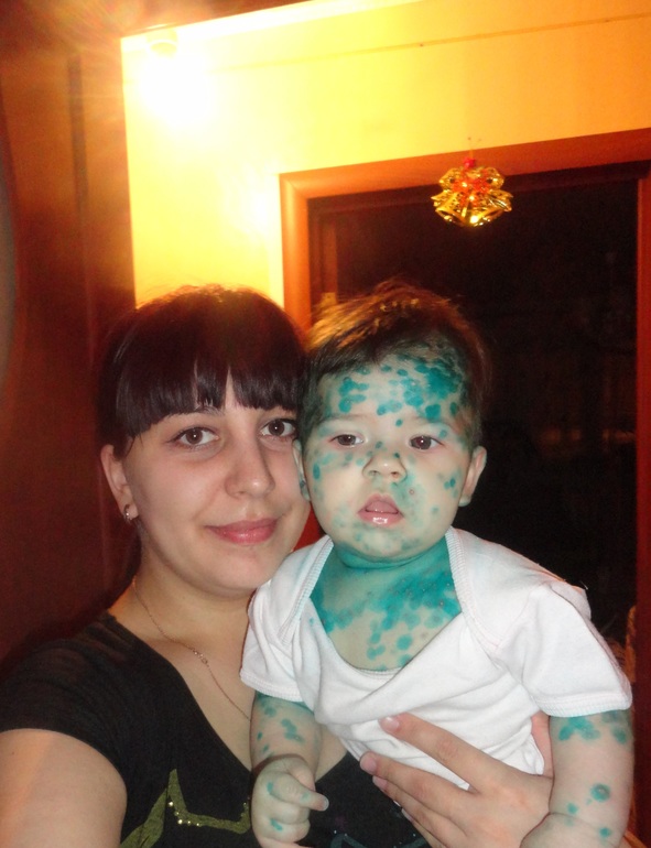 первые шаги к выздоровлению..... ветрянка. День 5.