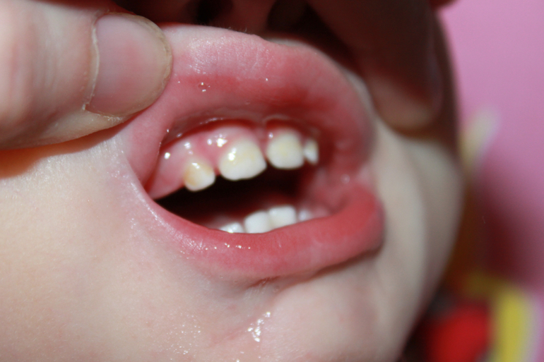 Лечение зубиков у 11 мес. малыша