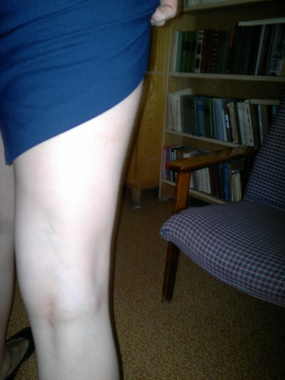 продолжение варикозной паранои.) фотки. ничего нового не увидите...