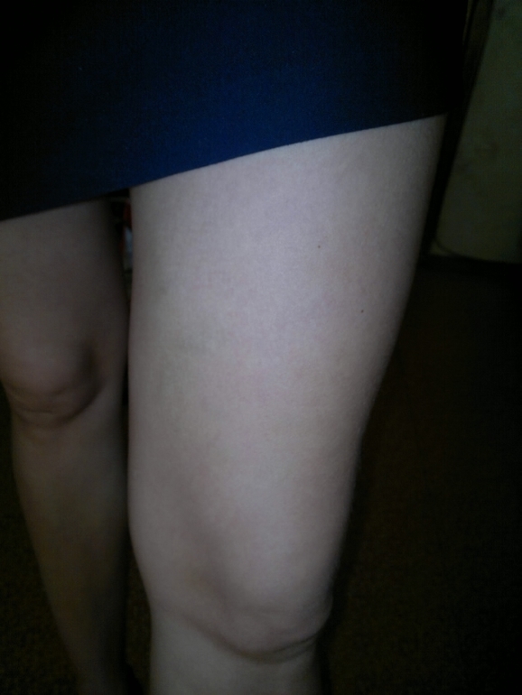 продолжение варикозной паранои.) фотки. ничего нового не увидите...