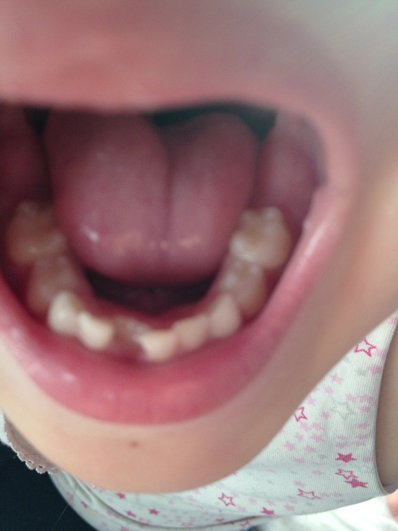 Помогите! Коренной зуб!