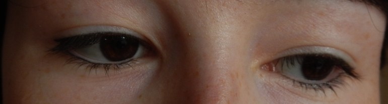 Межресничное пространство и стрелки.