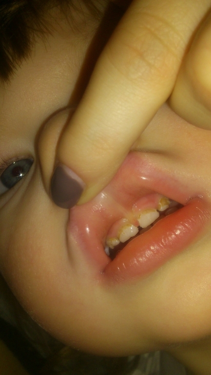 средний кариес?