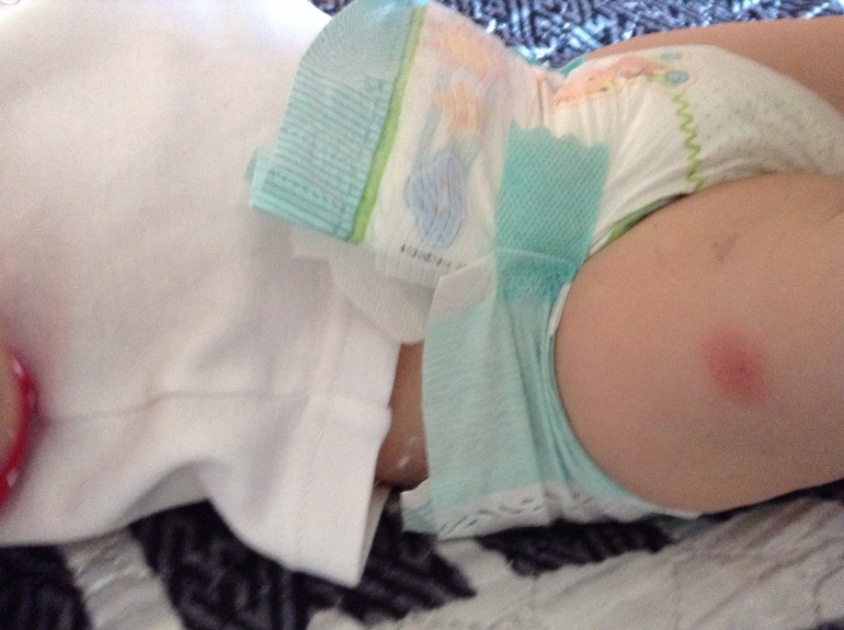 Прививка инфанрикс гекса