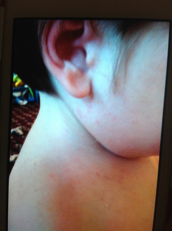 Что за сыпь?