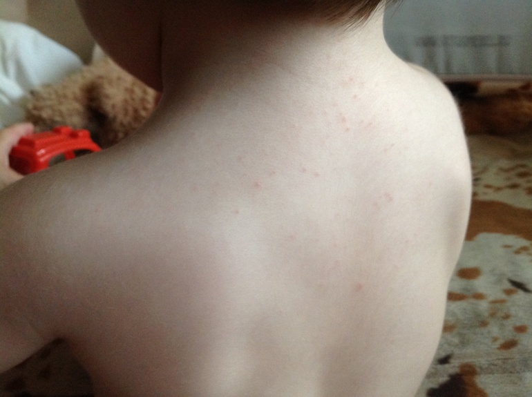 Что за сыпь?