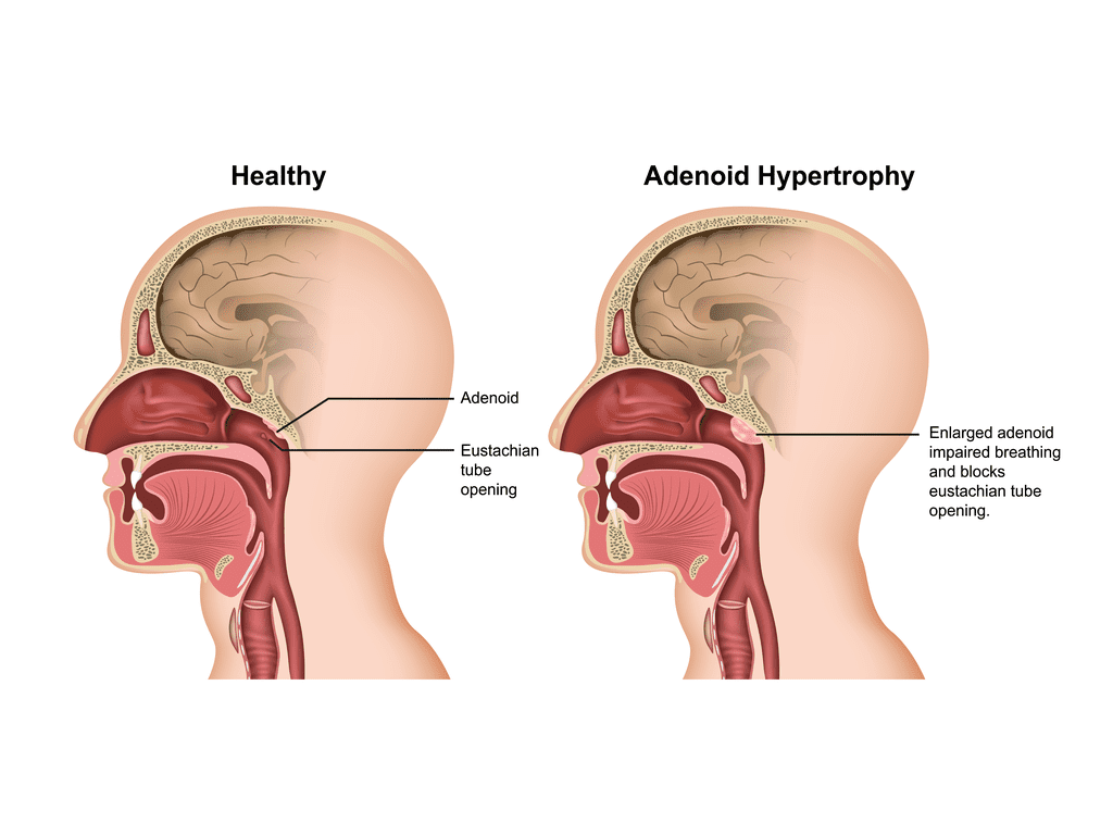 Аденоиды у детей — симптомы, причины и лечение - Дети - Babyblog