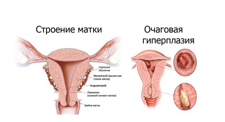 Гиперплазия эндометрия картинки