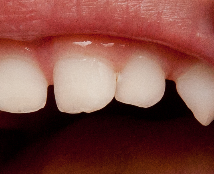 Начинается кариес?