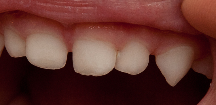 Начинается кариес?