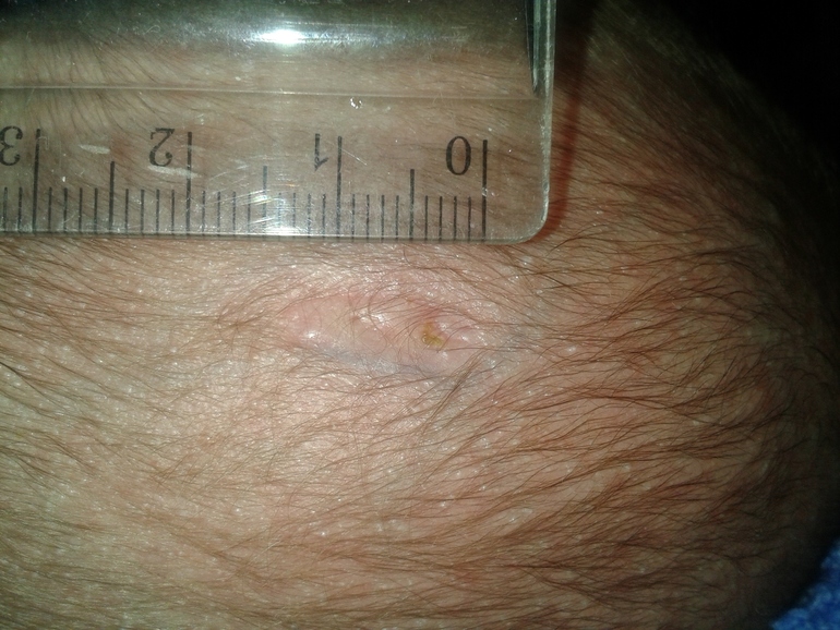 Здравствуйте! Шрам на головке родовой