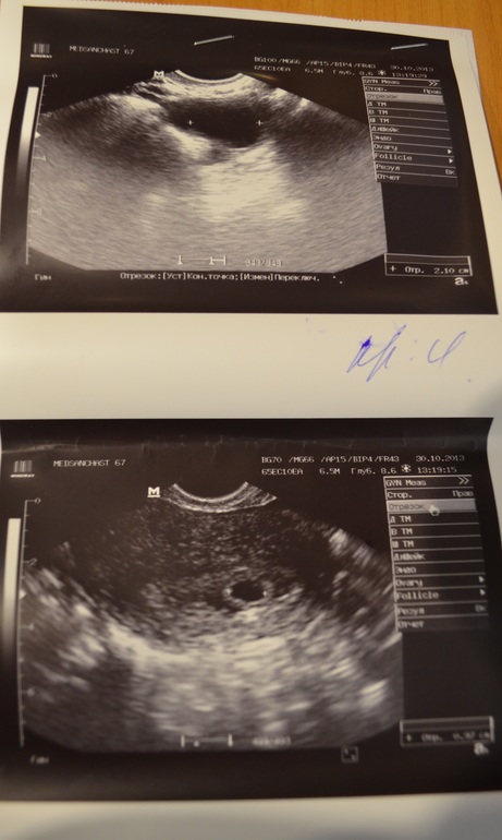 наше первое УЗИ