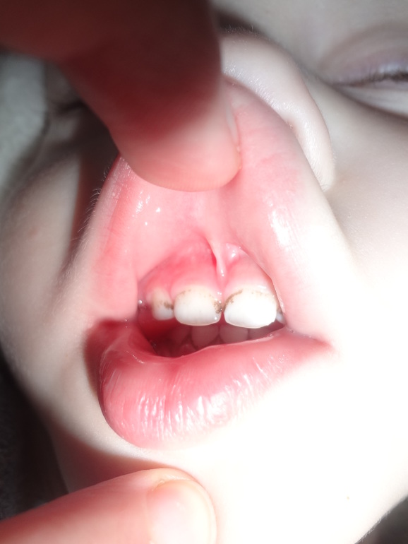 Налет на зубах