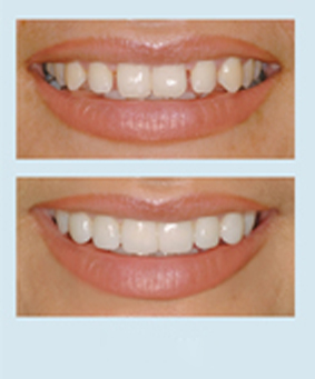 Щели между зубами