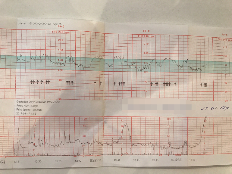 Ктг при схватках фото показатели