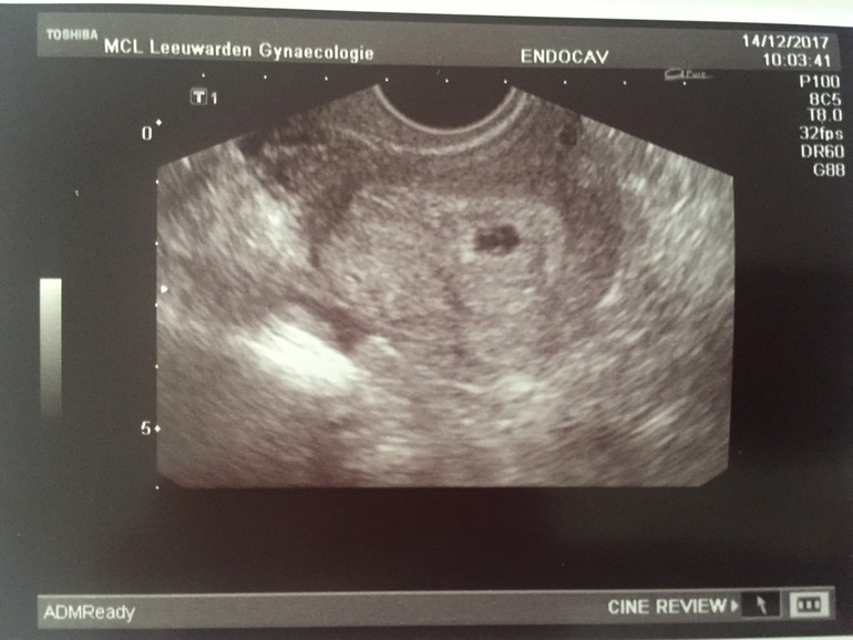 5 недель не видно беременность. Эмбрион в матке после переноса на УЗИ. УЗИ после переноса эмбрионов. Первое УЗИ после подсадки. Снимки УЗИ беременности.