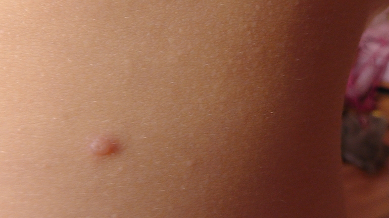 Это ветрянка или что........ ?