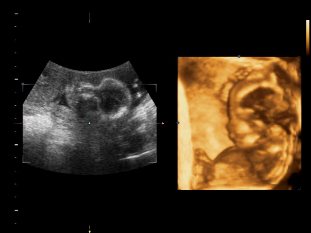 Сынуля был прав!!!! В пузике...