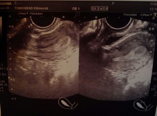Криоперенос узи. Эмбрион в матке после переноса на УЗИ. Темное пятно на УЗИ матки. Матка после подсадки эмбрионов.