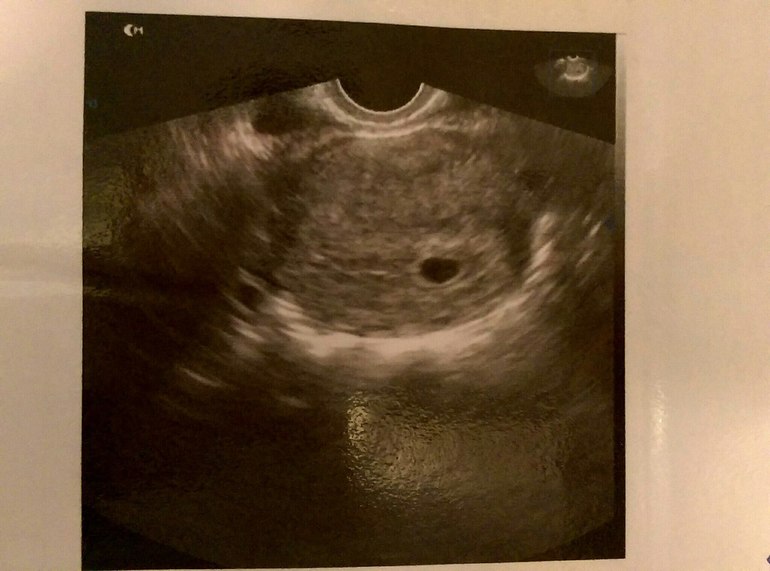 Снимок узи беременности 4 5 недель фото узи