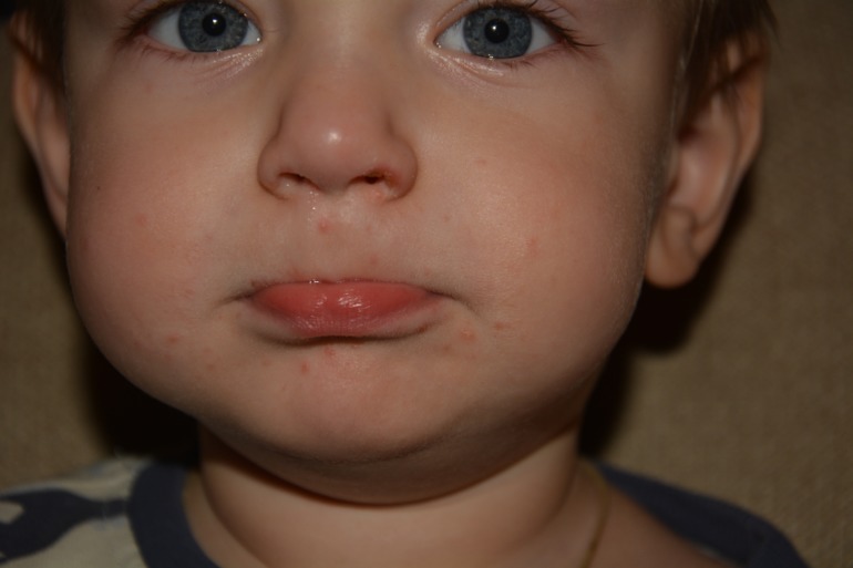 Что за прыщики?!