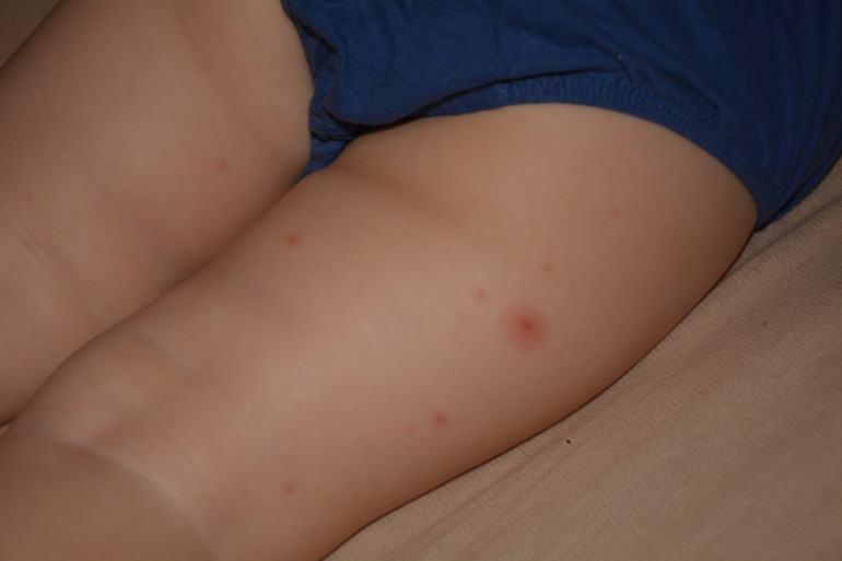 Что за прыщики?!