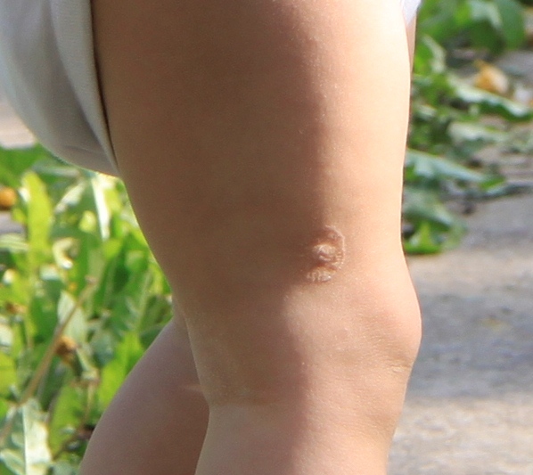 Фото до и после криодеструкции