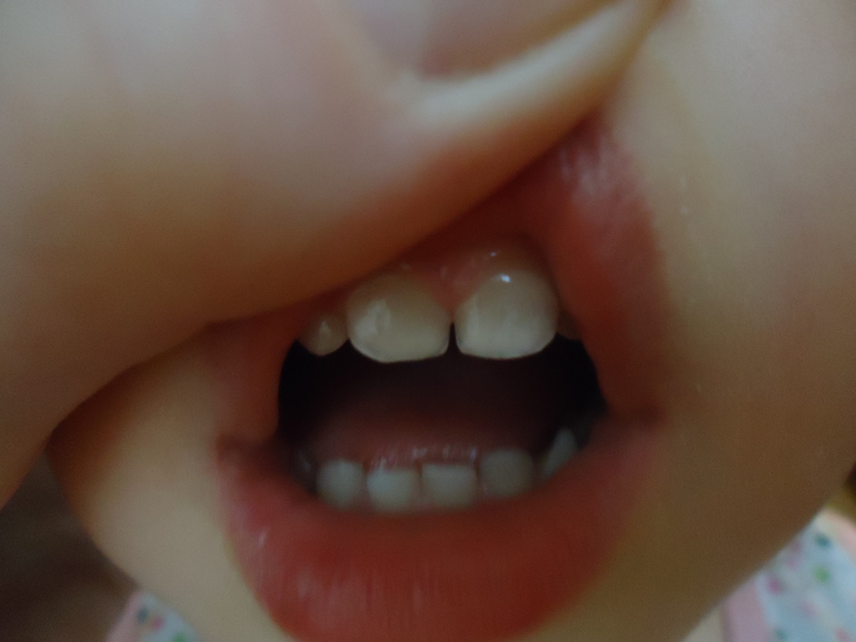 Неоднородный окрас эмали или...?