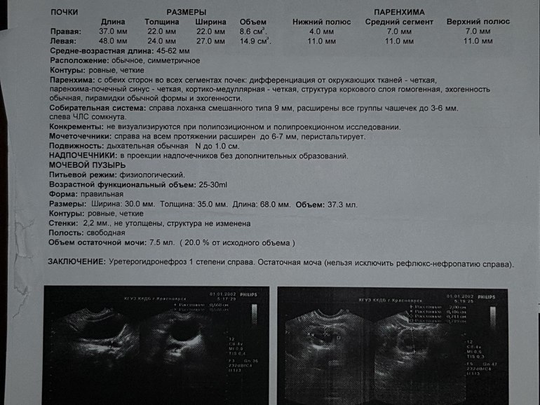 Норма почки у женщин по возрасту таблица. УЗИ мочевого пузыря остаточная моча норма. УЗИ мочевого пузыря заключение норма. УЗИ объем остаточной мочи в норме. Ультразвуковое исследование почек объем в норме.