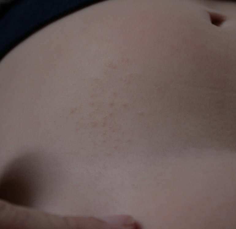 Высыпания. Что это?