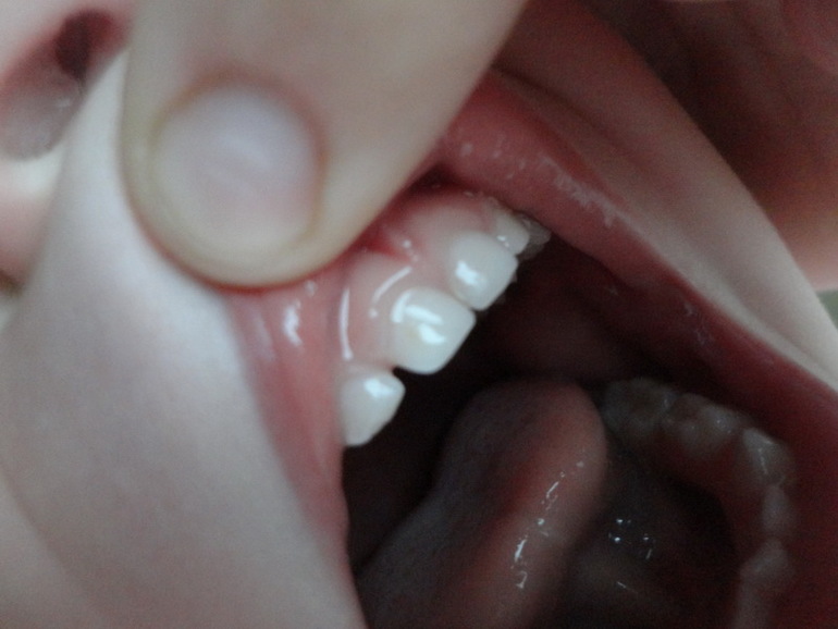 Кариес?!