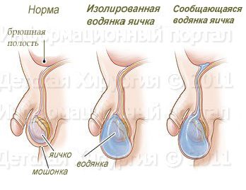 Водянка яичка (гидроцеле) - причины, симптомы, диагностика, лечение (операция)