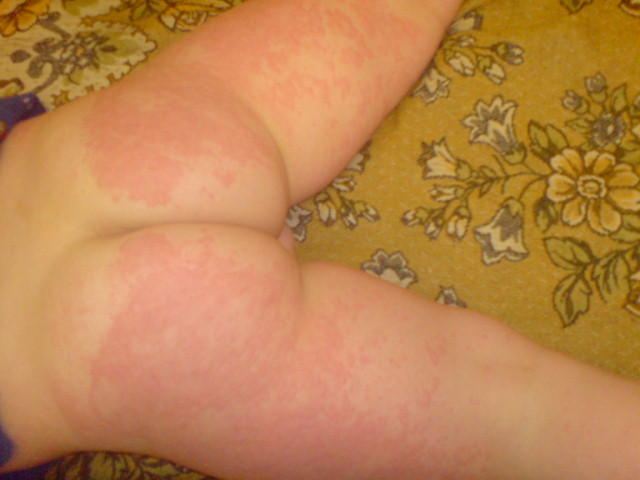 Крапивница.