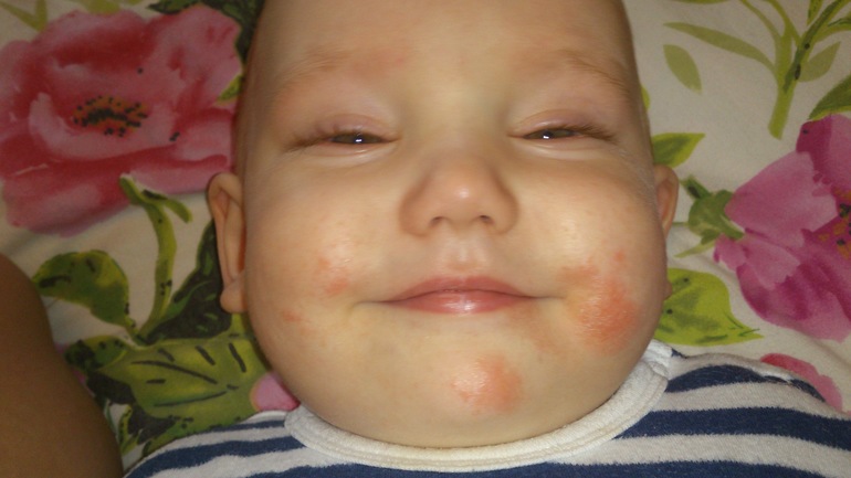 Аллергия или что-то ещё?