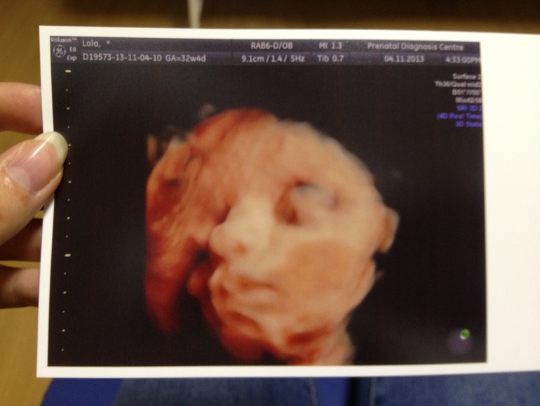 УЗИ 32 недели + 4 дня