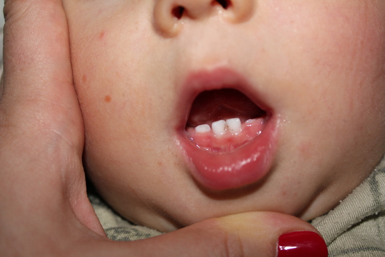 кариес? или что?