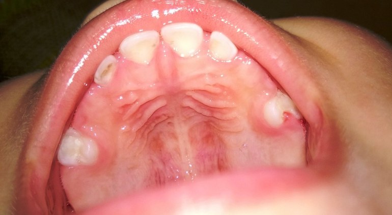 На какой стадии кариозный процесс?