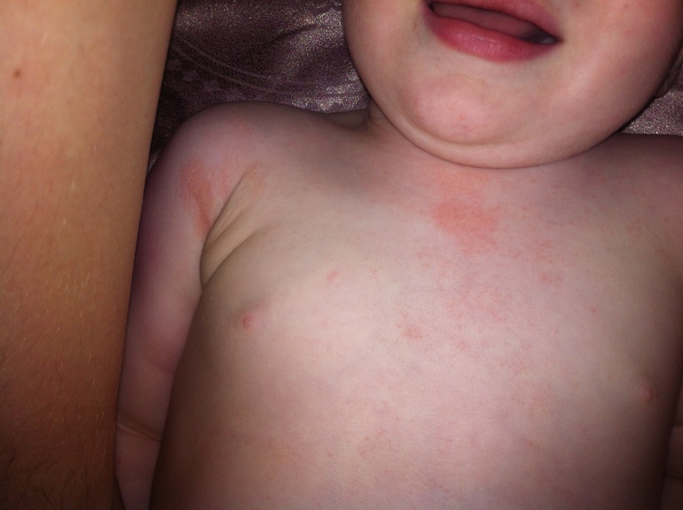 Аллергия или..?