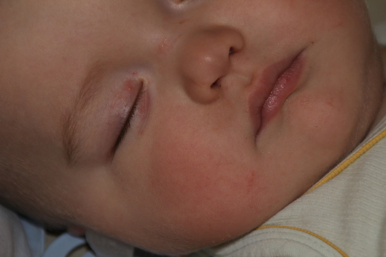 Псориаз? или что?