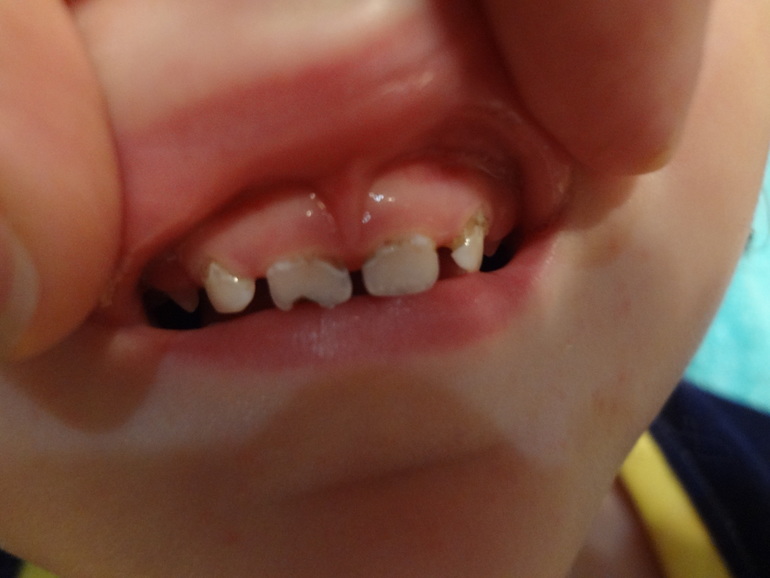 Кариес на резцах!
