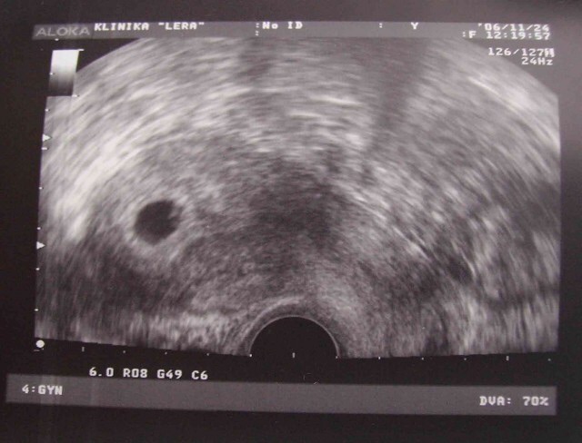 Как выглядит плод на 6 неделе беременности фото узи