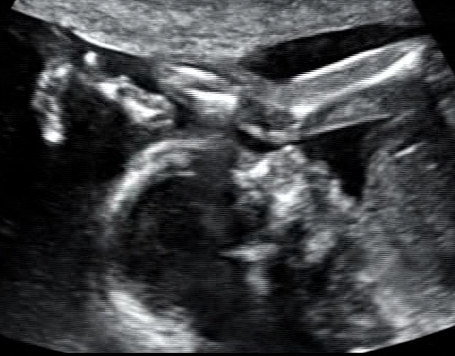 Стоп-кадры УЗИ (из видеоматериала)