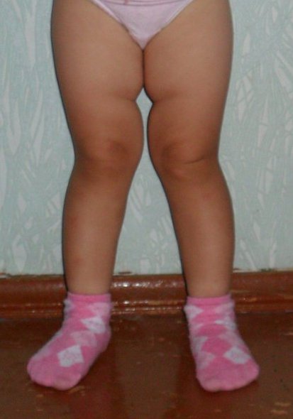 Х образные ноги у ребенка 2 лет фото