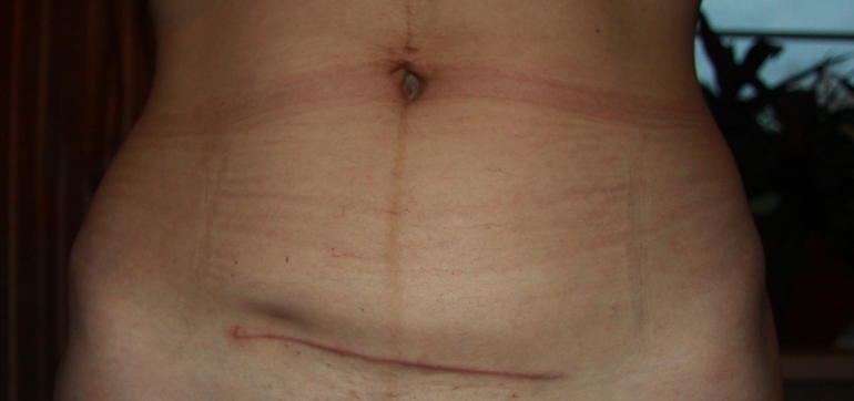 впадина на одной стороне шрама