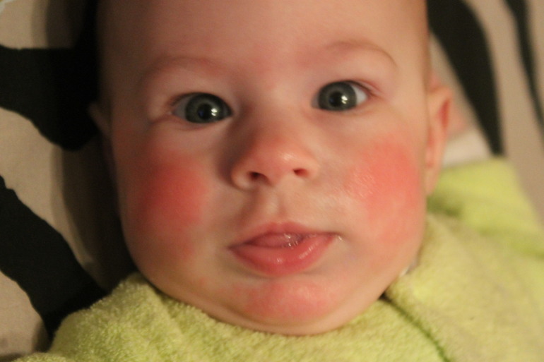 Покраснение на щеках,бороде и носу!