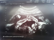 Фото УЗИ на 26 неделе беременности