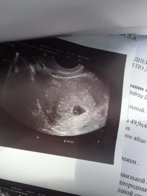 Беременность 5 недель фото. УЗИ 3-5 недели беременности. УЗИ на 5 акушерской неделе беременности. УЗИ 4 недели беременности акушерских. Эмбрион на 5 неделе беременности УЗИ.